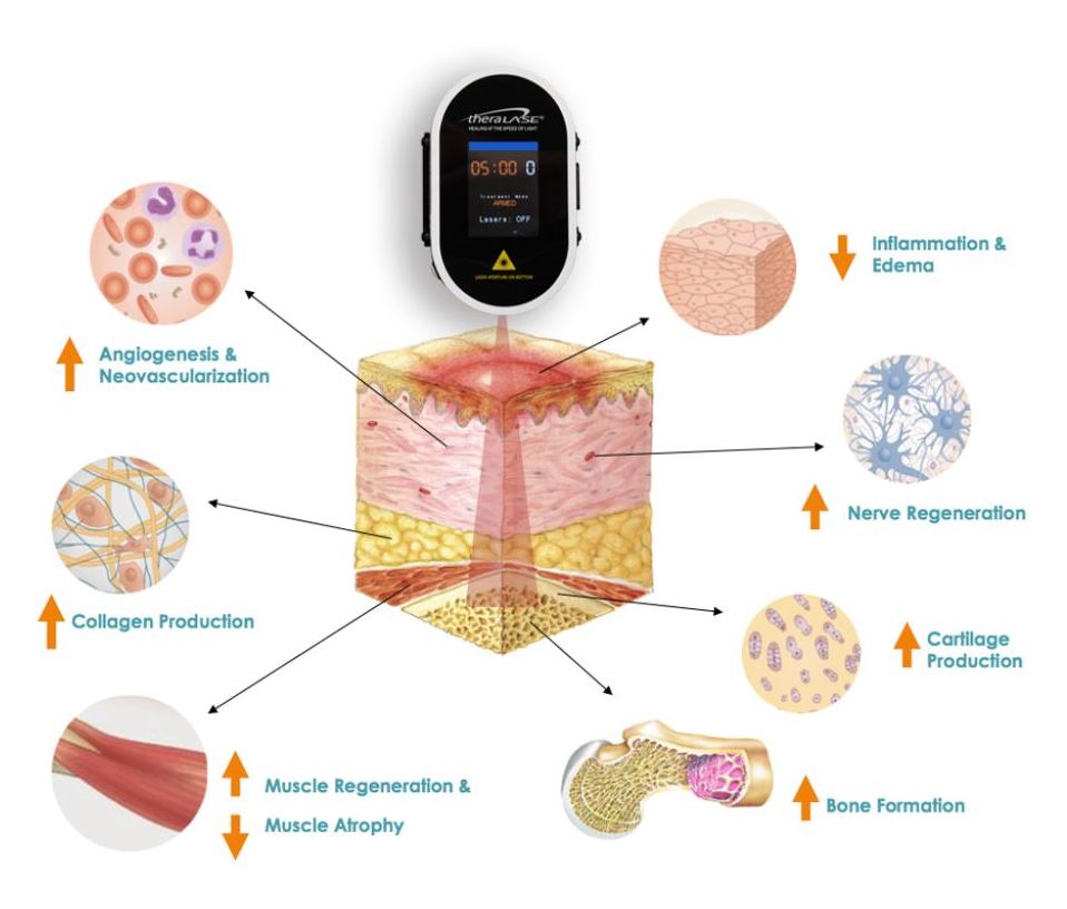 Laser Treatment Diagram